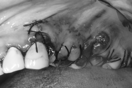 ロール 抜歯 エディ カプセル 骨粗しょう症で加療中。根がうずく歯の抜歯をめぐり悩ましい状況